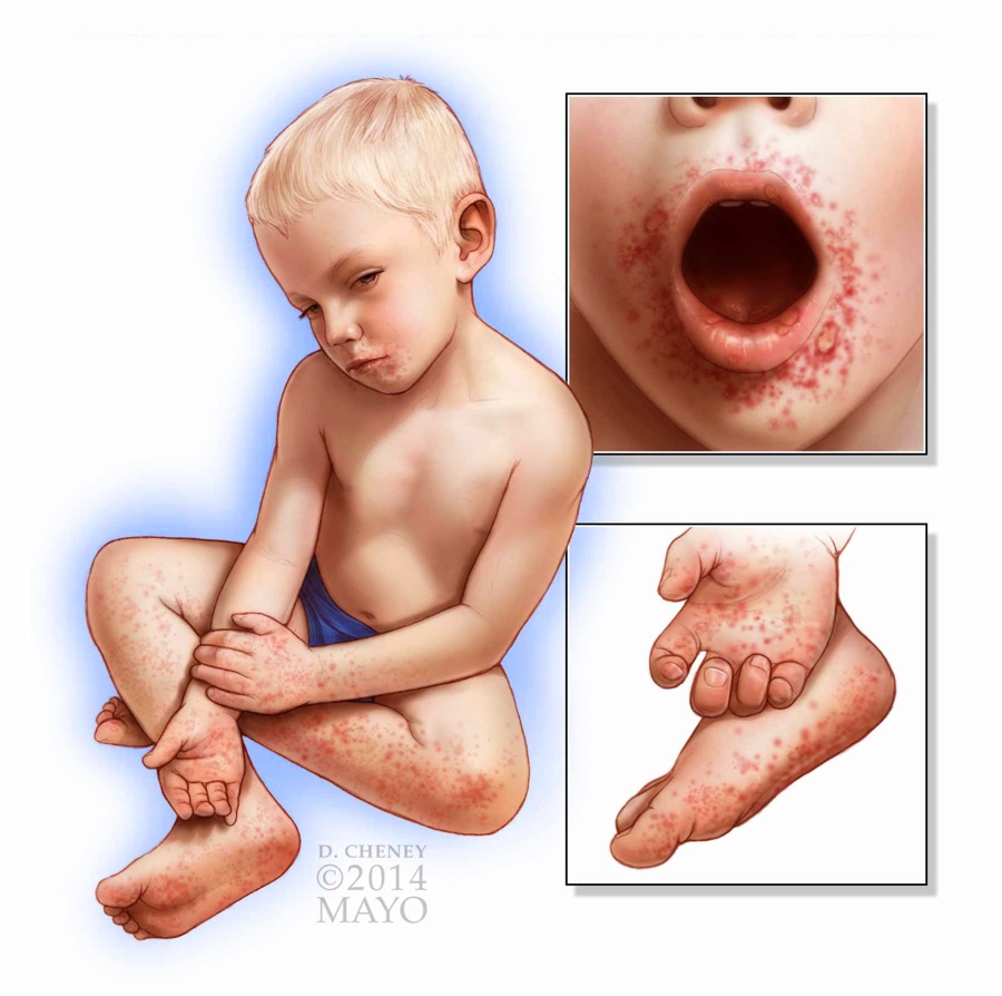 doenca-mao-pe-boca-pediatria-sintomas